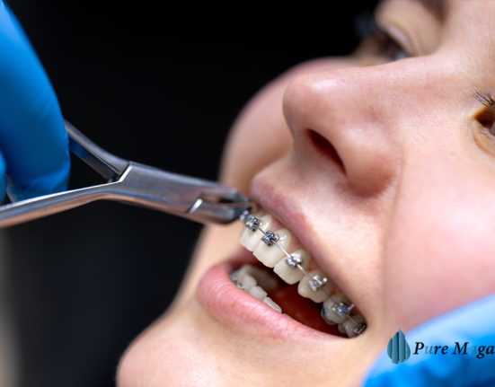 how much do braces cost