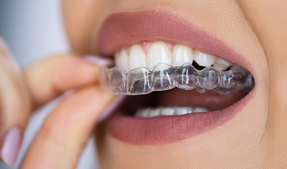 Invisalign