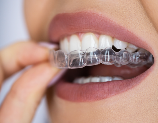 Invisalign