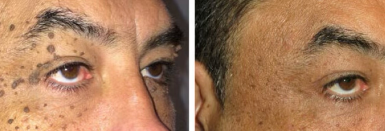 Eyelid