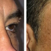 Eyelid