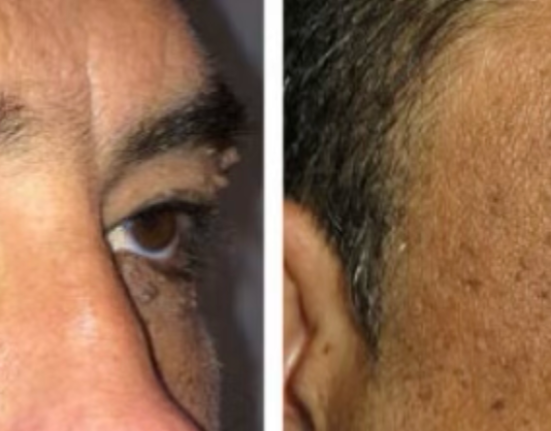 Eyelid