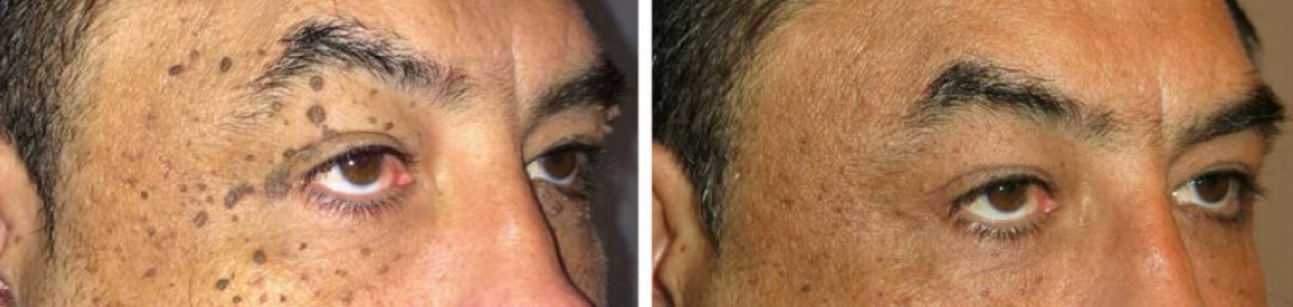 Eyelid