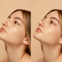Rhinoplasty
