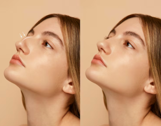 Rhinoplasty
